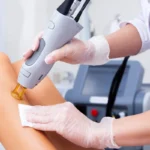 Hair removal with laser