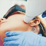 Laser hair removal