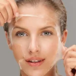 Chemical Peeling