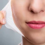 Chemical Peeling