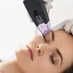 RF Microneedling