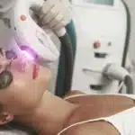 Top Benefits of Laser Hair Removal